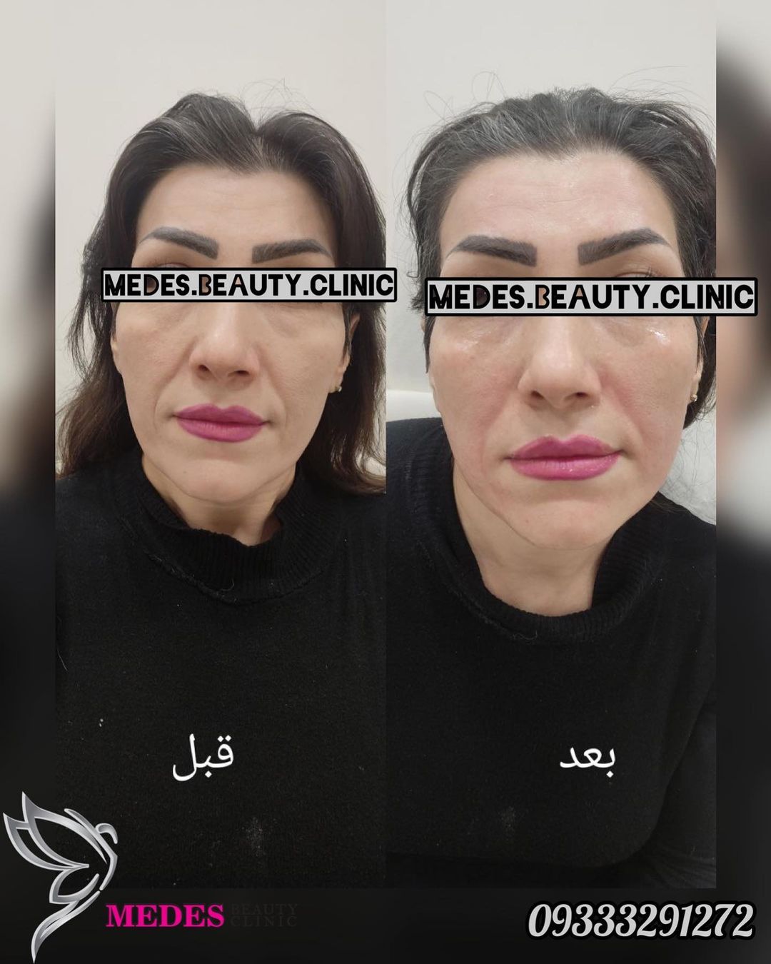 گالری هایفوتراپی